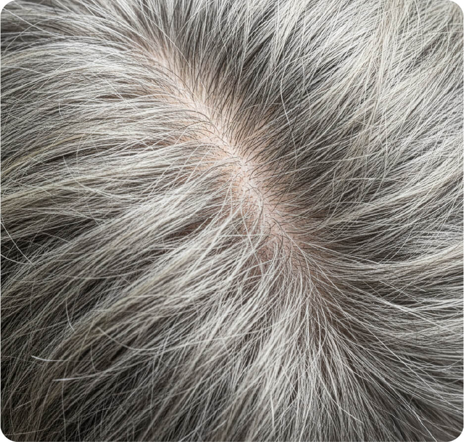 Nahaufnahme einer Kopfhaut mit dünner werdendem, grauem Haar – symbolisiert geschwächtes Haar und Nährstoffmangel, den Hair Luxious von innen ausgleicht.